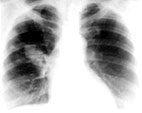 Editorial alerta para os números da tuberculose no país